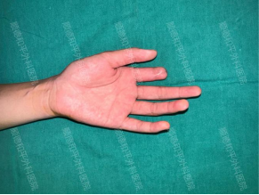 15岁少女的“重生手指”：顺德和平外科医院全型再造术点亮青春梦想