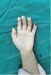 指尖上的“生死时速”——顺德和平外科医院3岁男童断指再植纪实