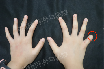 顺德和平外科医院：7岁女孩的手指再造供区与受区“平衡”住了吗？
