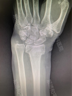 微创腕关节镜:桡骨远端闭合性骨折“不开刀”复位